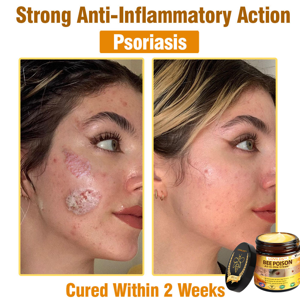 US-Approved Bee Poison Cream for All Skin Concerns