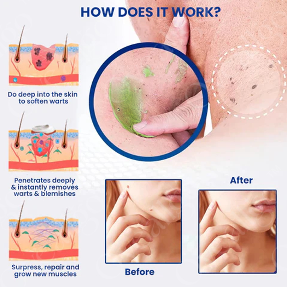 ✅ Official Store:  LOVILDS™ Ultra NatureErase Instant Mole & Spot Removal Gel