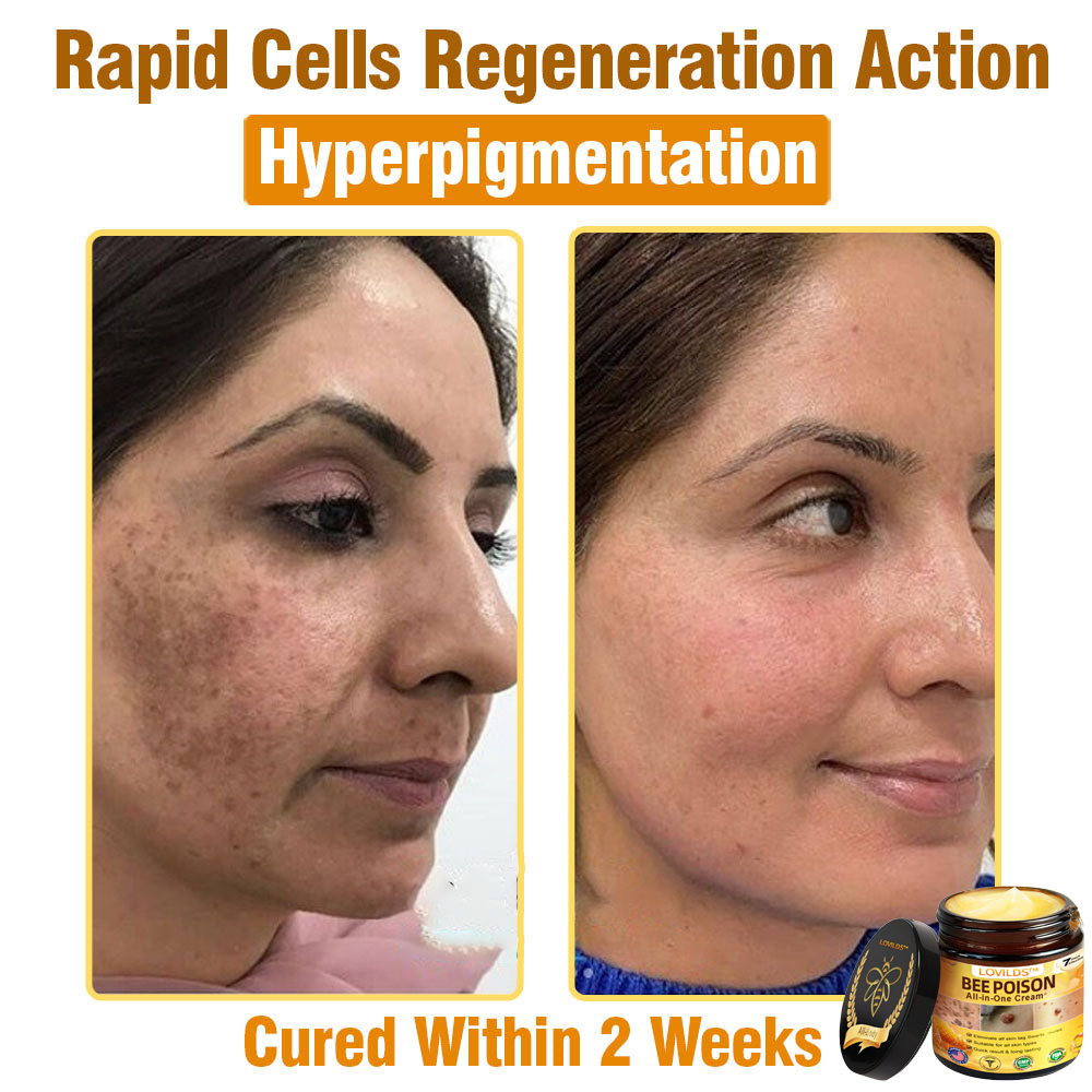 US-Approved Bee Poison Cream for All Skin Concerns