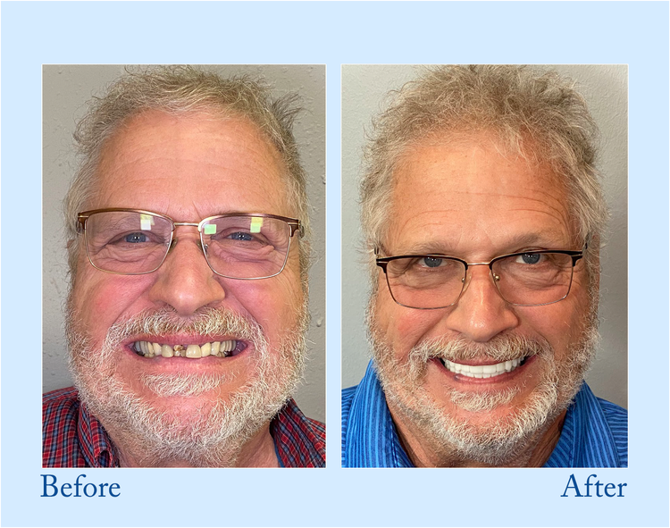 NESLEMY-🦷Advanced Customized Full Denture Set🦷 (⏰Limited time discount last 30 minutes⏰)