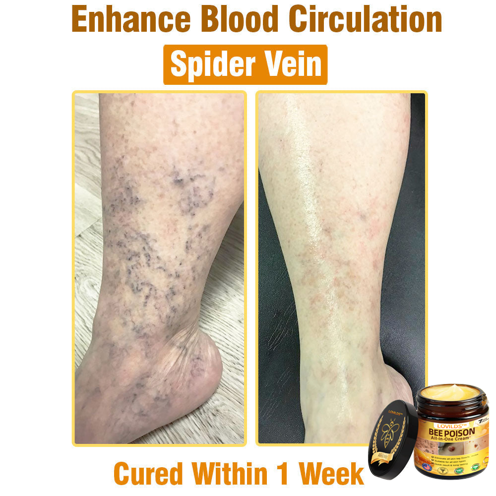 US-Approved Bee Poison Cream for All Skin Concerns