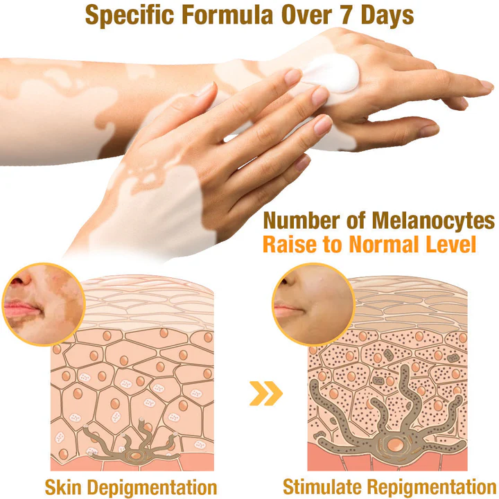 LOVILDS™ BeeVenom Vitiligo Treatment Cream (🔥80% Off for a Limited Time!)