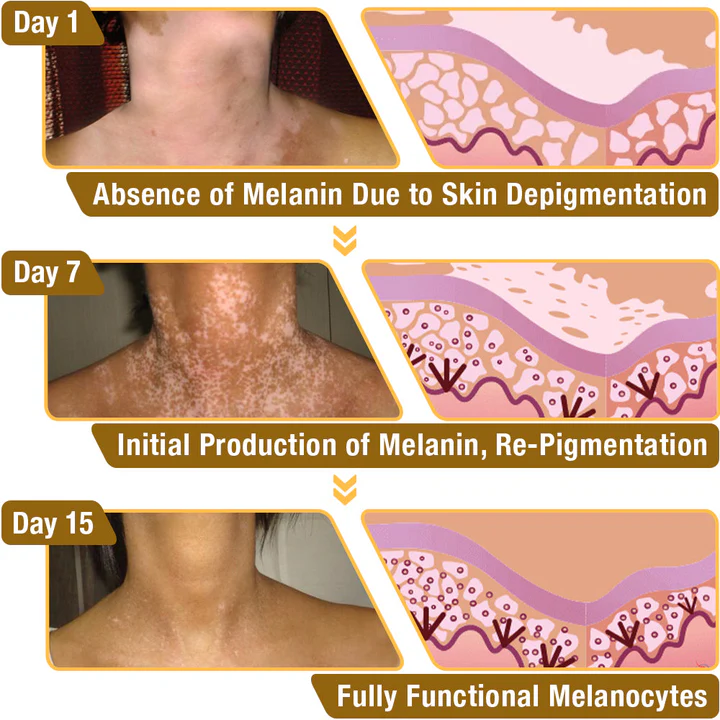 LOVILDS™ BeeVenom Vitiligo Treatment Cream (🔥80% Off for a Limited Time!)