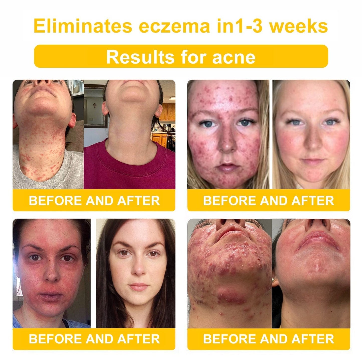 NESLEMY™ Bee Venom Skin Cream（👨‍⚕AAD Recommended),for Remove Warts, Acne and Scars