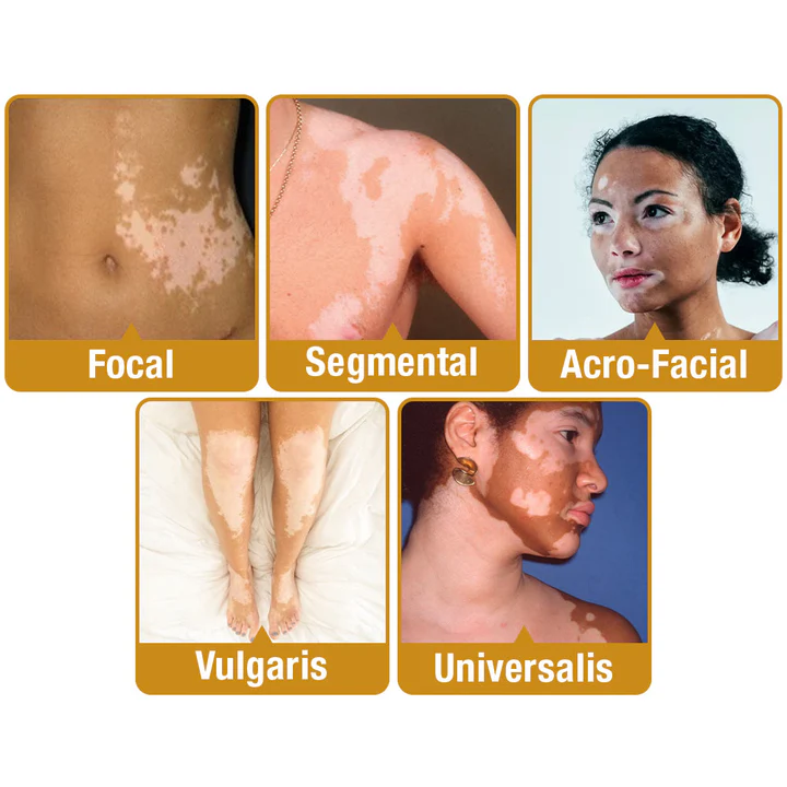 LOVILDS™ BeeVenom Vitiligo Treatment Cream (🔥80% Off for a Limited Time!)