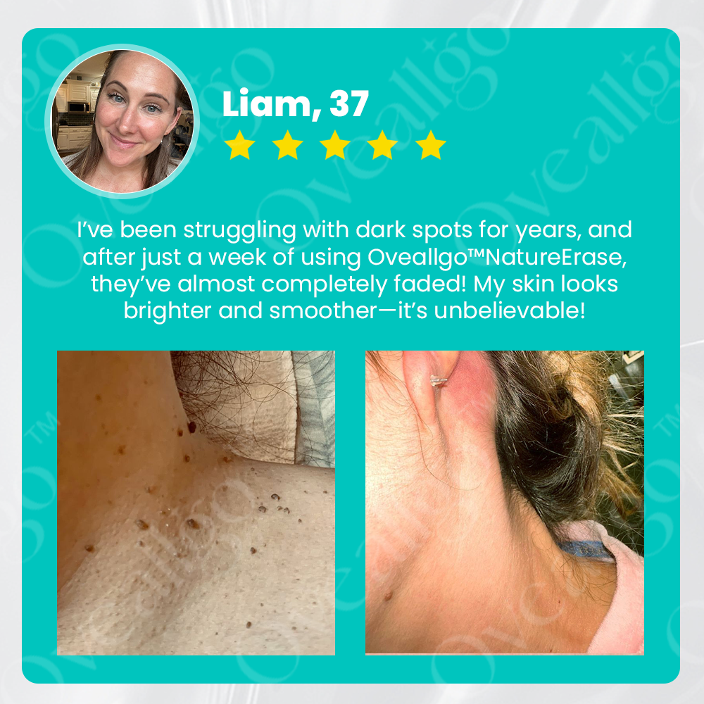 ✅ Official Store:  LOVILDS™ Ultra NatureErase Instant Mole & Spot Removal Gel
