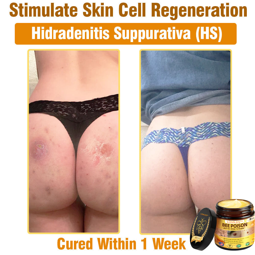 US-Approved Bee Poison Cream for All Skin Concerns
