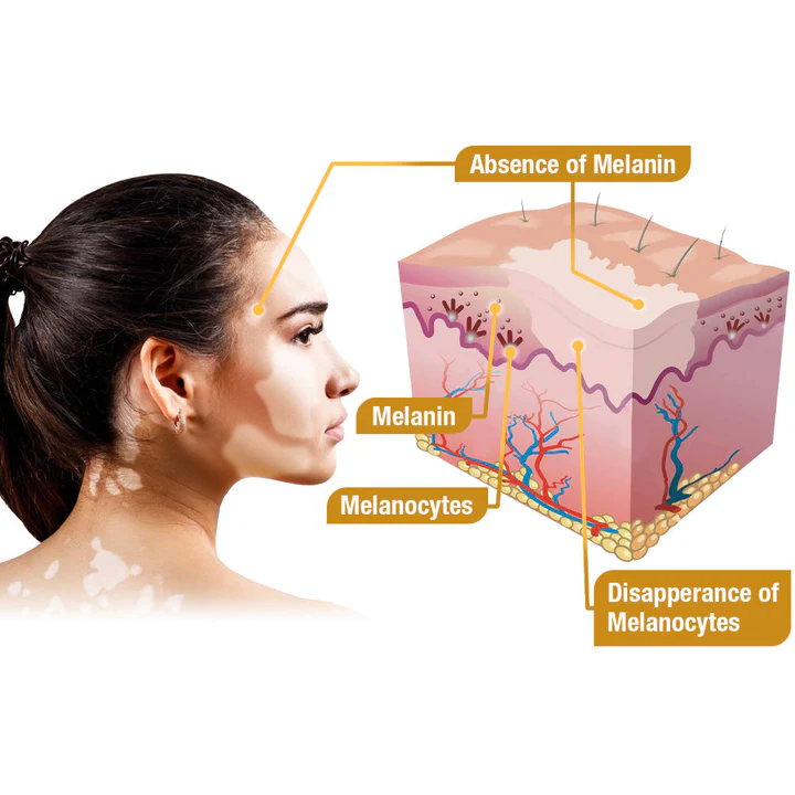 LOVILDS™ BeeVenom Vitiligo Treatment Cream (🔥80% Off for a Limited Time!)
