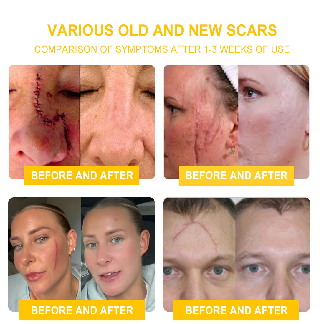 NESLEMY™ Bee Venom Skin Cream（👨‍⚕AAD Recommended),for Remove Warts, Acne and Scars