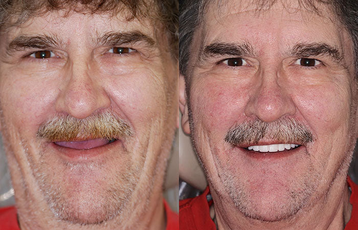 NESLEMY™ --🦷Advanced Customized Full Denture Set🦷