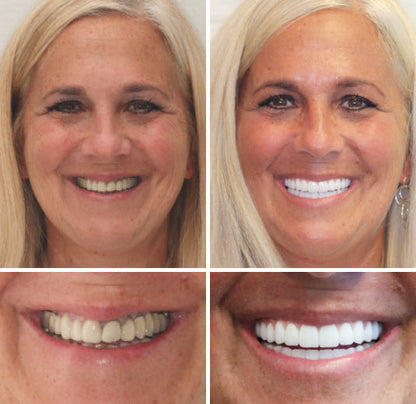 NESLEMY™ --🦷Advanced Customized Full Denture Set🦷