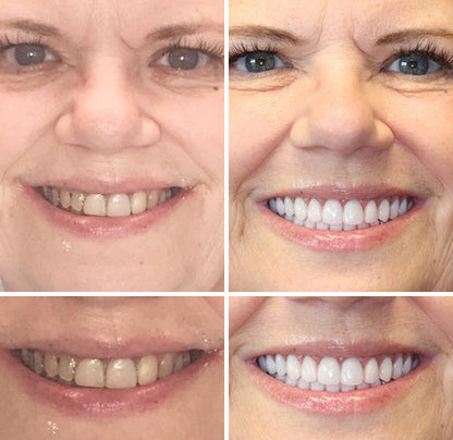NESLEMY™ --🦷Advanced Customized Full Denture Set🦷