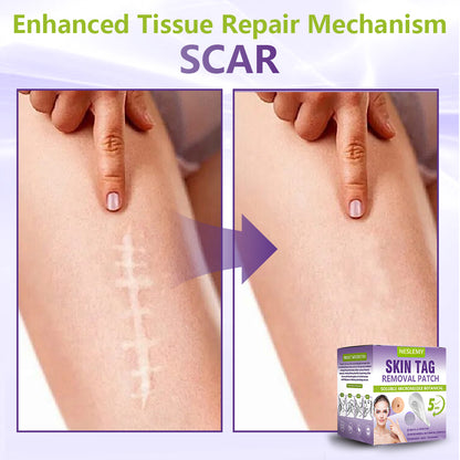 NESLEMY® Soluble Microneedle Botanical Skin Tag Removal Patch