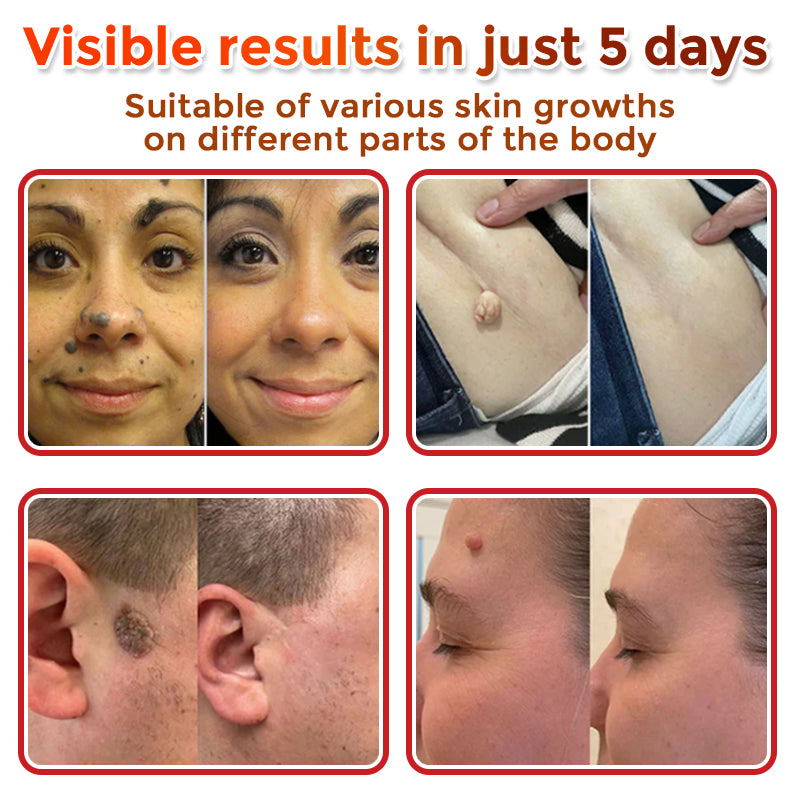 🌈LOVILDS® MicroNeedle Botanic Skin Tag Removal Patch 🇺🇸 Made in the USA