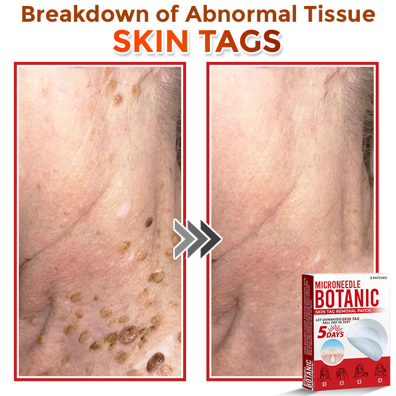 🌈LOVILDS® MicroNeedle Botanic Skin Tag Removal Patch 🇺🇸 Made in the USA
