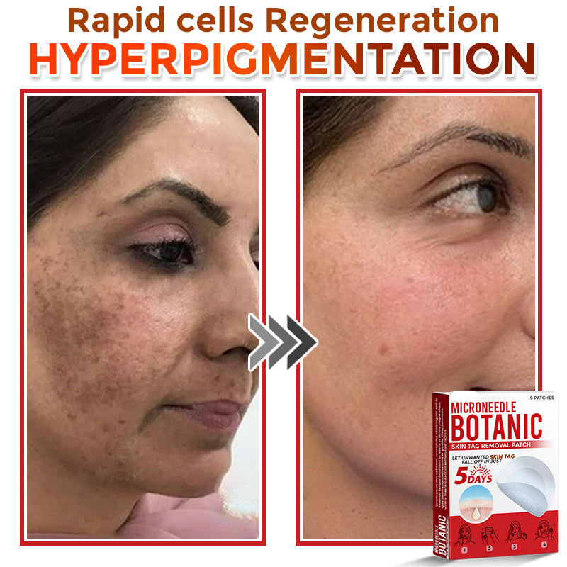 🌈LOVILDS® MicroNeedle Botanic Skin Tag Removal Patch 🇺🇸 Made in the USA