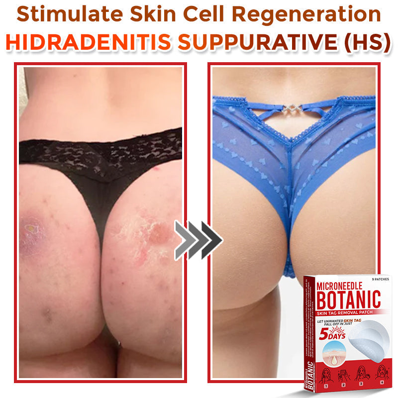 🌈LOVILDS® MicroNeedle Botanic Skin Tag Removal Patch 🇺🇸 Made in the USA