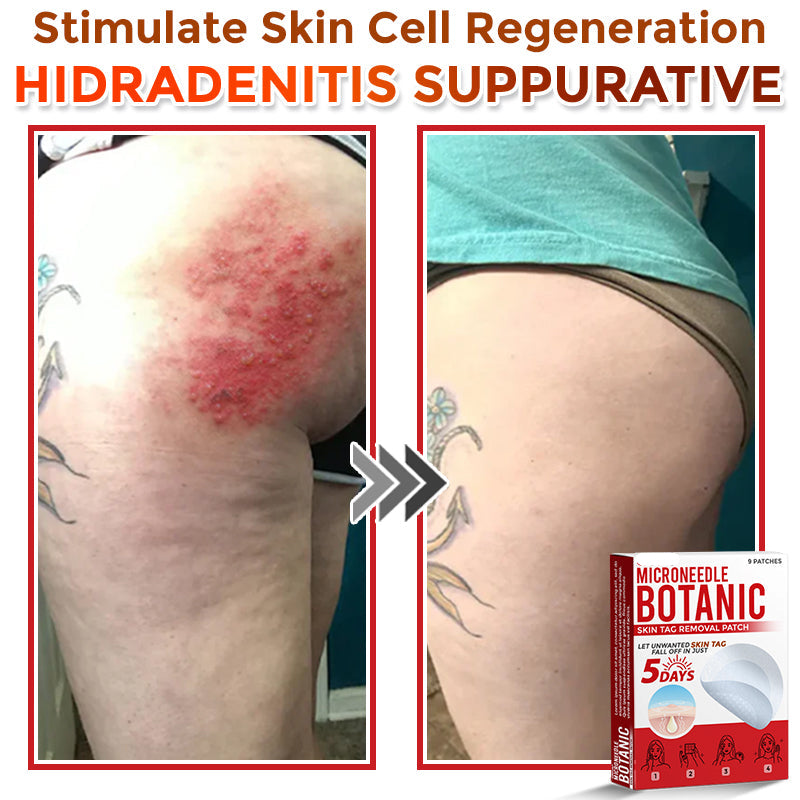 🌈LOVILDS® MicroNeedle Botanic Skin Tag Removal Patch 🇺🇸 Made in the USA