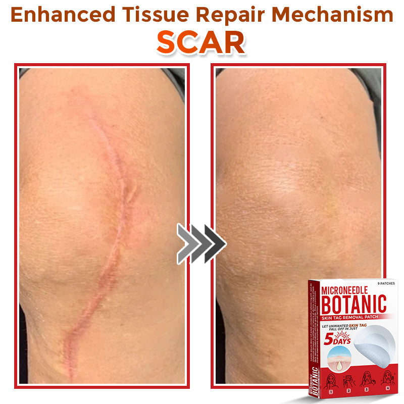 🌈LOVILDS® MicroNeedle Botanic Skin Tag Removal Patch 🇺🇸 Made in the USA