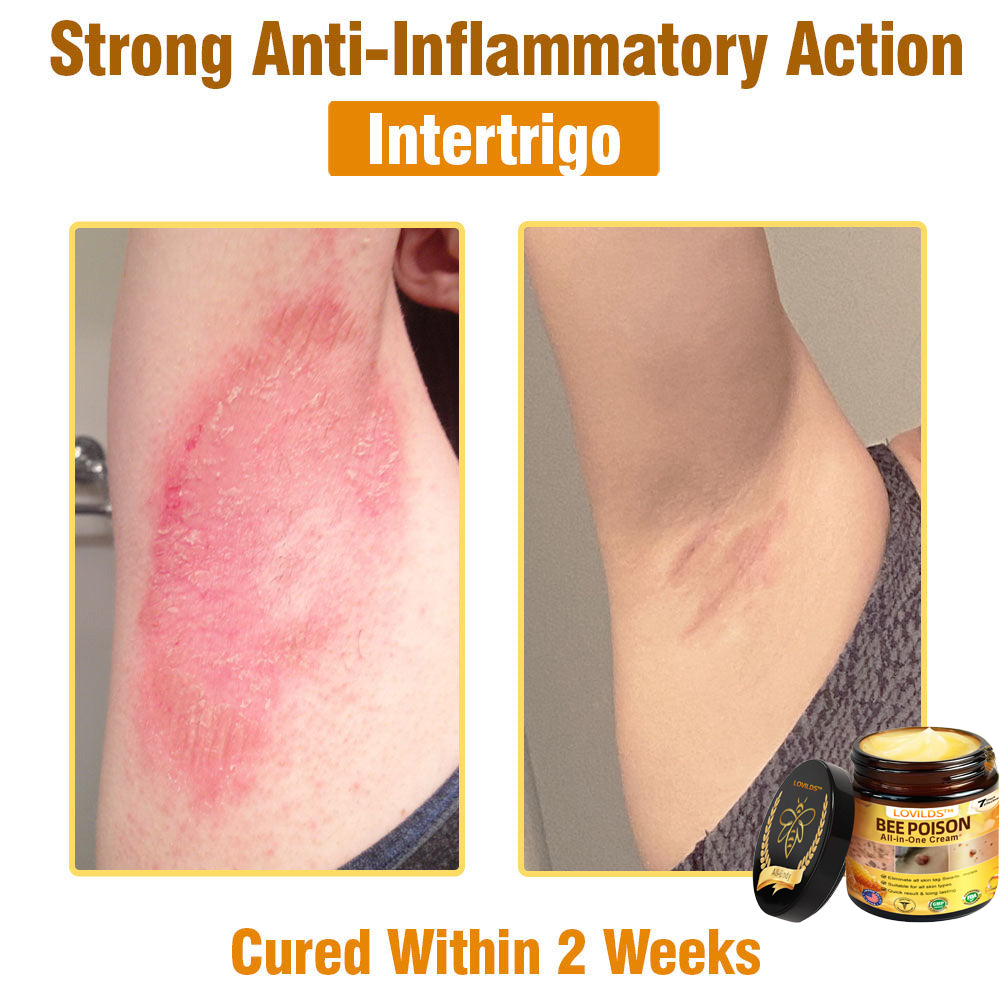 US-Approved Bee Poison Cream for All Skin Concerns