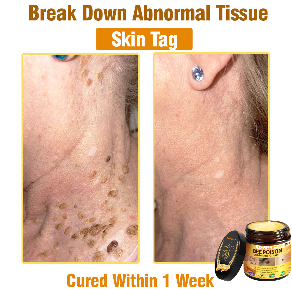US-Approved Bee Poison Cream for All Skin Concerns