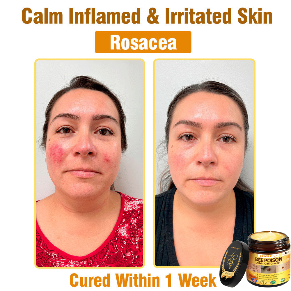 US-Approved Bee Poison Cream for All Skin Concerns
