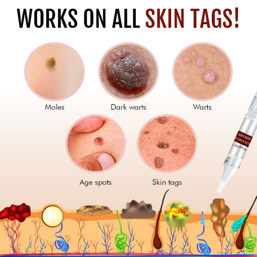 ✨BUY 1 GET 1 FREE✨ Lovilds™ Tags & Moles Remover