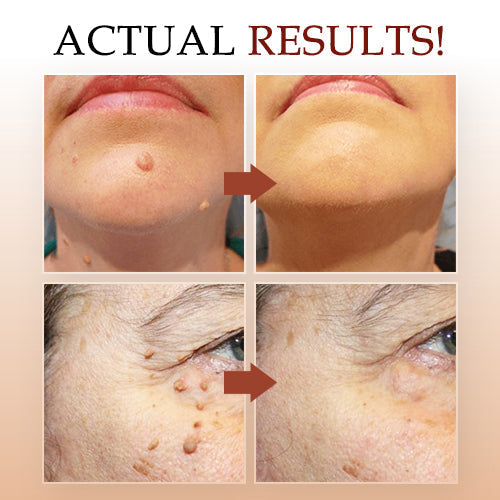 ✨BUY 1 GET 1 FREE✨ Lovilds™ Tags & Moles Remover